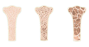 ossos-com-osteoporose