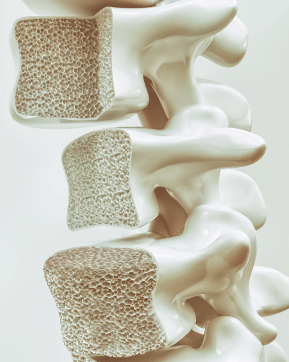 tratamento-osteoporose